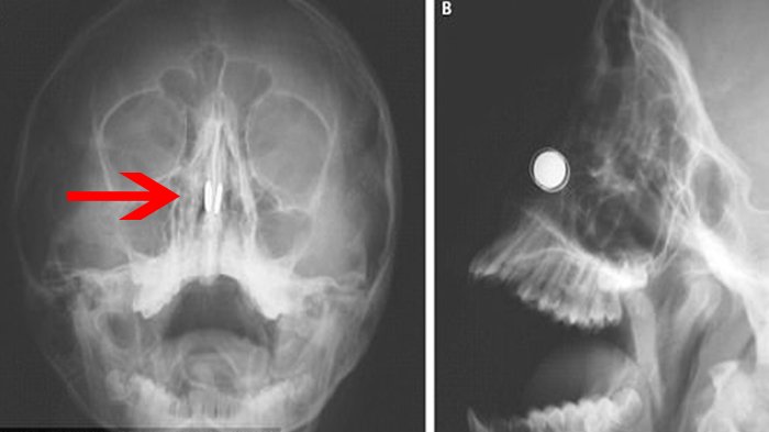 Dokter Keluarkan 2 Magnet yang Menempel Erat di Hidung Bocah ini dengan Cara Unik
