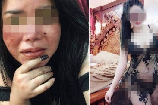 Posting Foto Seksi, Wajah Wanita Cantik Ini Bonyok Dihajar Pacar