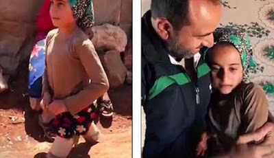 Diamputasi, Ayah Ganti Dua Kaki Putrinya dengan Kaleng Sarden