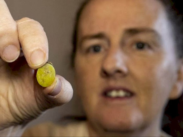 37 Tahun Kesulitan Bernafas, Ternyata Tiddlywinks 'Bersarang' di Dalam Hidung Wanita Ini