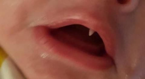 Tumbuh Gigi Taring Seperti Vampir, Bayi 11 Minggu ini Viral!