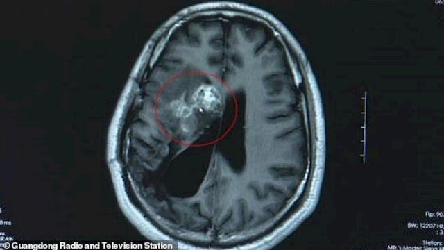 Otak Pria Ini Digerogoti Cacing Pita 12 Cm, Awalnya Dikira Tumor Ganas