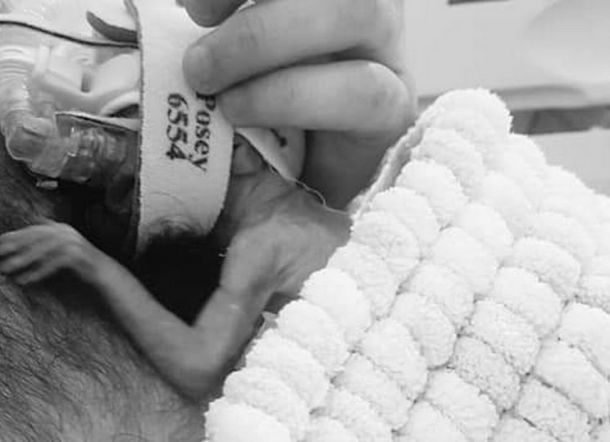 Lahir Prematur, Bayi Ini Seukuran Coklat Batang