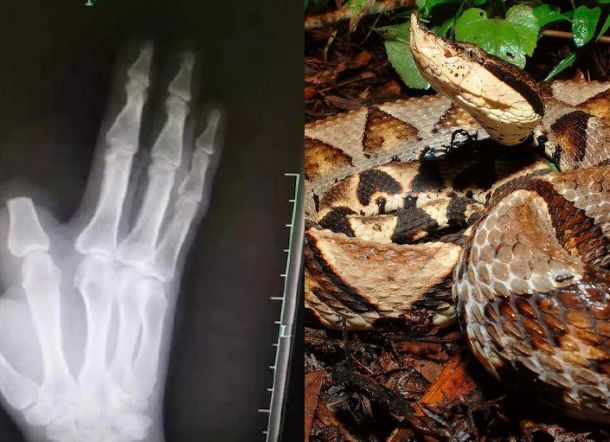 Petani Potong Jarinya Setelah Digigit Ular, Kemudian Diberitahu Itu Tidak Berbisa