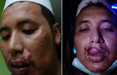 Ketua FPI Dipukuli Usai Ceramah PKI, Bibirnya Bonyok