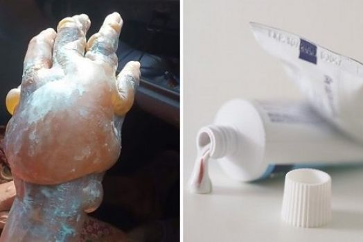 Jangan Gunakan Pasta Gigi untuk Luka Bakar