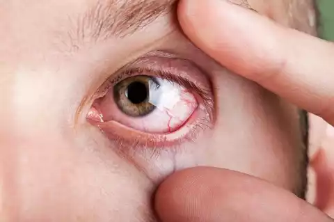 Begini Atasi Mata Merah Tanpa Obat