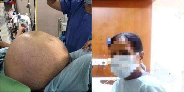 Perut Nirmala Bengkak Sampai Tak Bisa Nafas, Saat Dibedah Isinya Mengejutkan