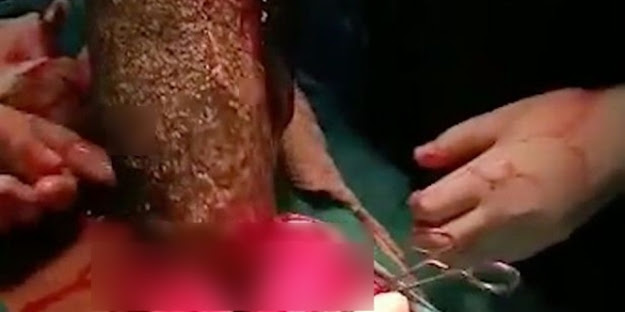 Dokter Keluarkan Gumpalan Rambut 7 Kg dari Perut Gadis 17 Tahun