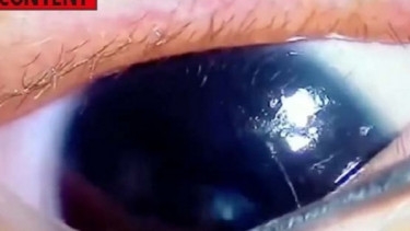 Video Viral Dokter Keluarkan 11 Cacing Parasit di Mata Bocah