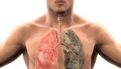 Hilangkan Tar dan Nikotin dari Paru-paru dengan Cara Alami Ini