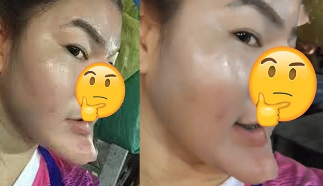 Wanita Ini Lakukan Operasi Hidung, Hasilnya Malah Menakutkan