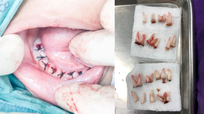 Kebiasaan Tidur dengan Botol Susu di Mulut, Gigi Bocah 4 Tahun Membusuk