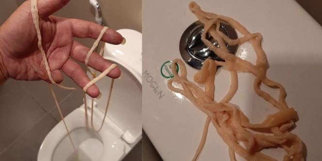 Serem! Dikira Tali Bekas Operasi, Pria Ini Keluarkan Cacing Pita 10 Meter Saat BAB
