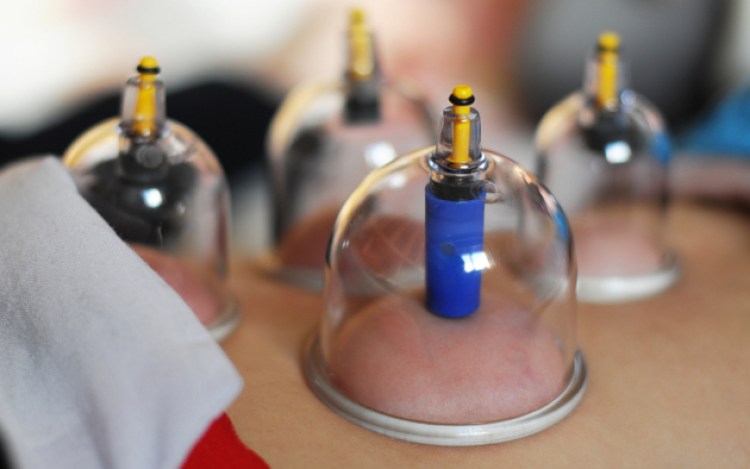 Darah Akibat Bekam Batalkan Wudhu?