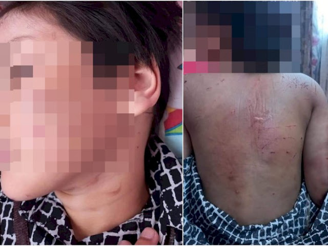 Bocah Tujuh Tahun ini Disiksa Nenek dan Tante, Sekujur Tubuh Luka dan Rusuk Patah