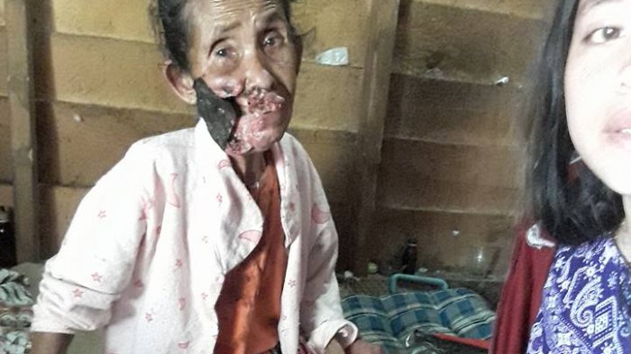 Tinggal di Rumah Kurang Layak, Nenek Mastia Menahan Sakit yang Mengerikan