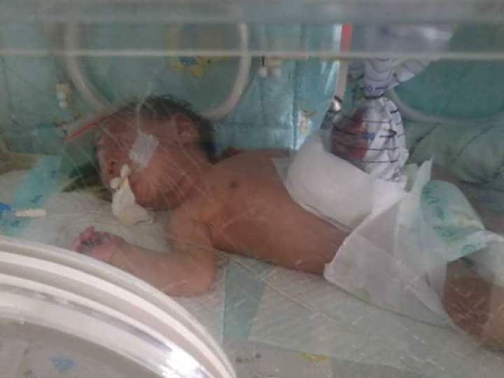 Pasca Operasi, Kondisi Bayi Usus Keluar Mulai Stabil