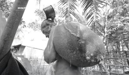 Kasihan... 40 Tahun Sudah Kakek Ini Hidup Dengan 'Tempurung Kura-kura' di Punggung