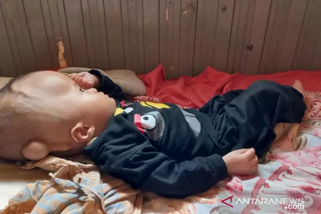 Menderita Hidrosefalus, Bocah Laki-Laki di Kecamatan Batang Tuaka Butuh Bantuan