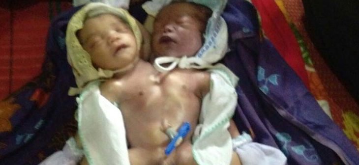 Bayi Kembar Siam di Tapteng, Sayangnya Meninggal Sesaat Dilahirkan