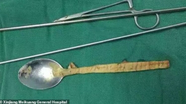 WADAW CUY... Sendok Sepanjang 20 cm Nyangkut di Kerongkongan