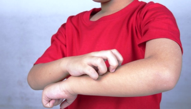 Kenapa Rasa Gatal di Kulit Malah Berlipat Ganda Saat Digaruk?