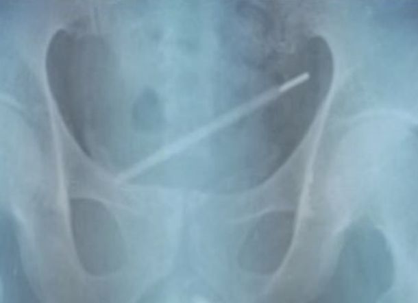 Pria ini Masukkan Termometer ke P*nis, Terjebak di Kandung Kemih 11 Hari