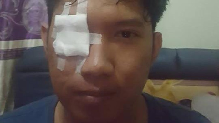 Kasus Iritasi Mata Parah karena Kena Abu Rokok Pengemudi di Jalan