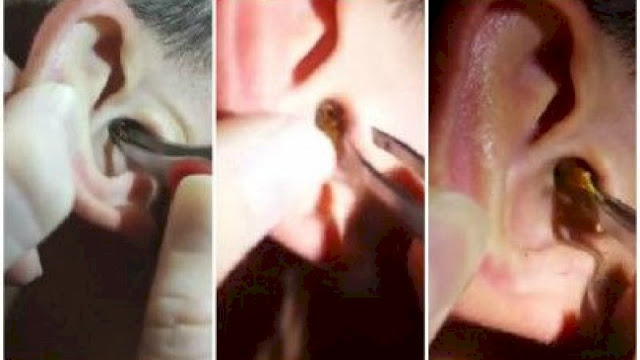 Dokter ini Berhasil Keluarkan Kotoran Telinga, Panjangnya 2,5 Cm