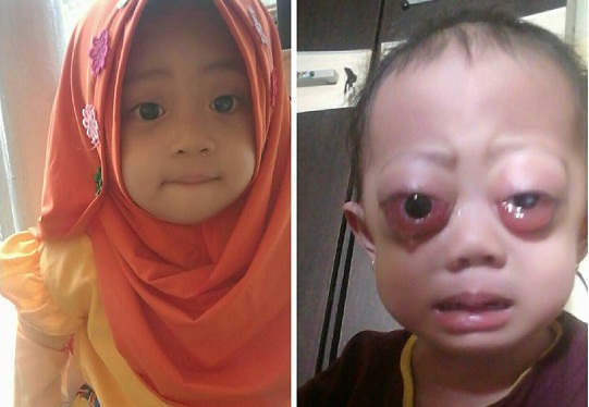 Bayi Cantik di Riau, Hayfa Alesha Derita Penyakit Langka, Bantu dengan Cara Begini