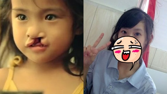 Dibuang saat Terlahir Sumbing, Begini Perlakuan Anak Ini ke Orang Tuanya saat Dewasa