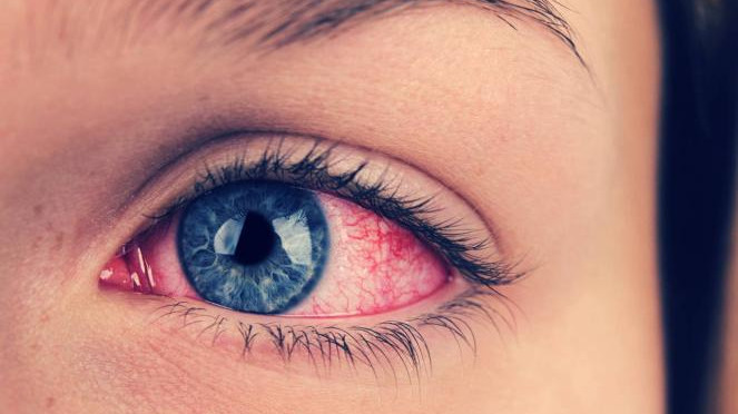 Mata Berselaput Benarkah Bisa Sebabkan Kebutaan?