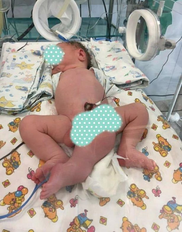 Bayi Ini Lahir dengan 3 Kaki dan 2 Penis dan Tanpa Anus