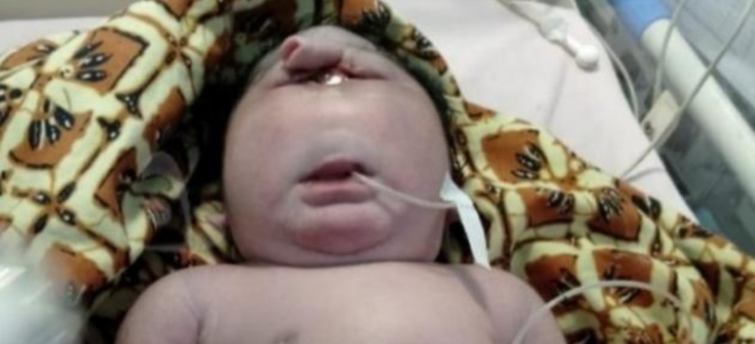 Bayi Lahir Mata Satu Tanpa Hidung di Riau