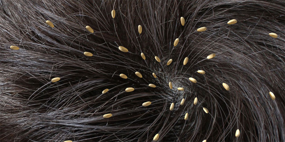 Mitos Kutu Rambut yang Sering Dianggap Fakta