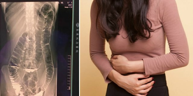 Selalu Sembelit, Kondisi Organ Wanita Ini Bikin Ngeri