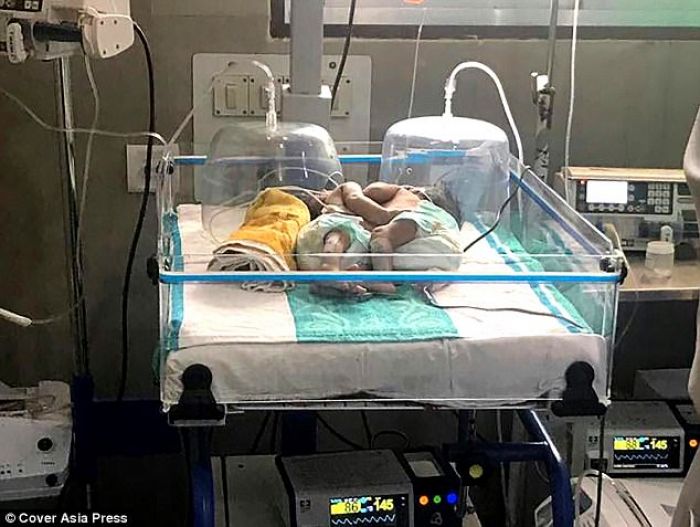 Tidak Pernah Cek Kehamilannya, Wanita Ini Melahirkan Bayi Kembar Siam yang Jantung dan Hatinya Menyatu