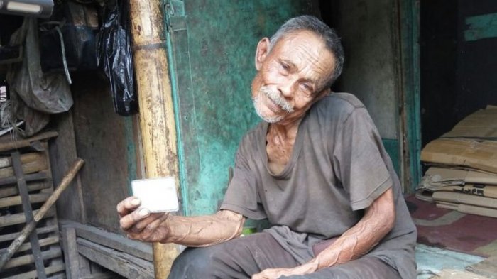 Pria Tua Ini Hidup Sebatang Kara dengan Leher Bengkok