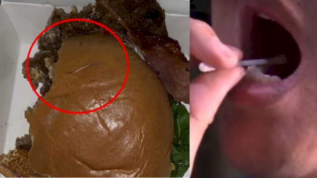 Lidah Pria Ini Terluka Setelah Makan Burger, Pas Dicek Ada Jarum Panjang