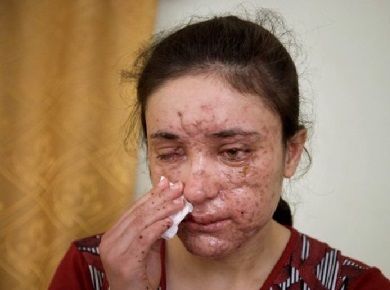 Wajah Budak Seks ISIS Hancur Terkena Ranjau saat Kabur