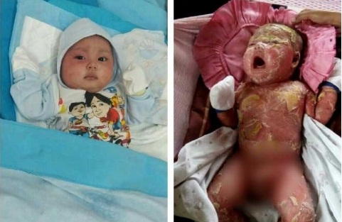 Biaya Perawatan Muhammad Alhafizi Ditanggung Pemerintah 