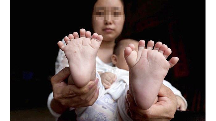 Bayi ini Lahir dengan 31 Jari, Padahal Saat Dalam Kandungan Dokter Katakan Tak ada Kelainan