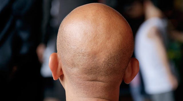 Selama ini Pakai Wig. Istri Lapor Polisi, Merasa Ditipu Ternyata Suaminya Botak