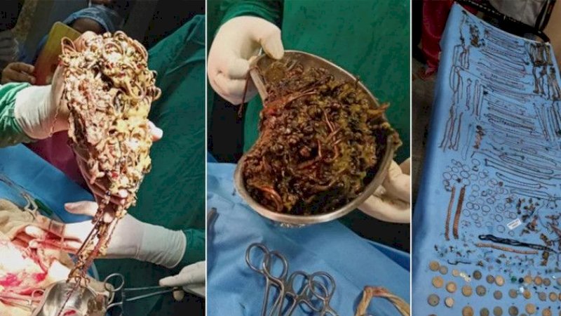 Dokter Temukan 69 Rantai, 80 Anting, dan 11 Cincin Saat Membelah Perut Wanita Ini. Kok Bisa?