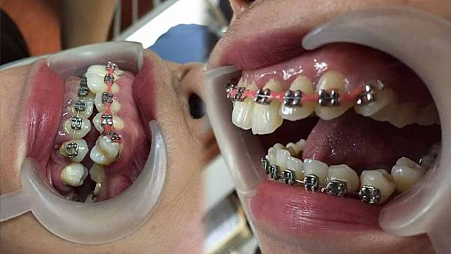 Gigi Wanita Ini Nyaris Hancur Setelah Pasang Kawat Gigi Palsu yang Dibeli secara Online